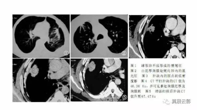 全球肺炎動態(tài)更新，共同應(yīng)對挑戰(zhàn)與未來展望